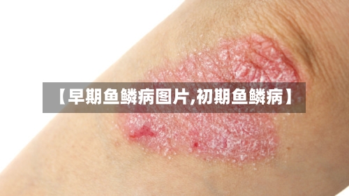 【早期鱼鳞病图片,初期鱼鳞病】-第1张图片