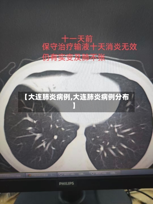 【大连肺炎病例,大连肺炎病例分布】-第3张图片